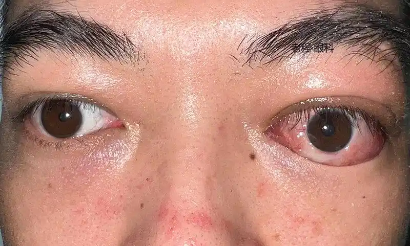 甲亢突眼_治疗方式_缓解方法 - 好大夫在线