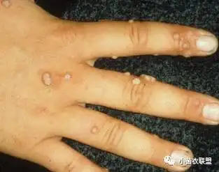 寻常疣怎么治疗