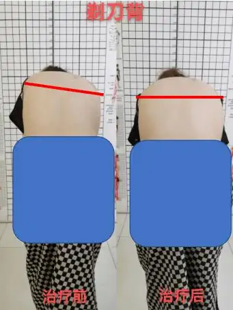 长期肩背疼痛来我科就诊,查体评估后发现患者胸段脊柱侧弯,出现剃刀背
