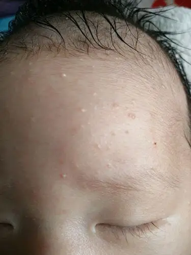 宝宝脸上起粉刺怎么回事?不是热的