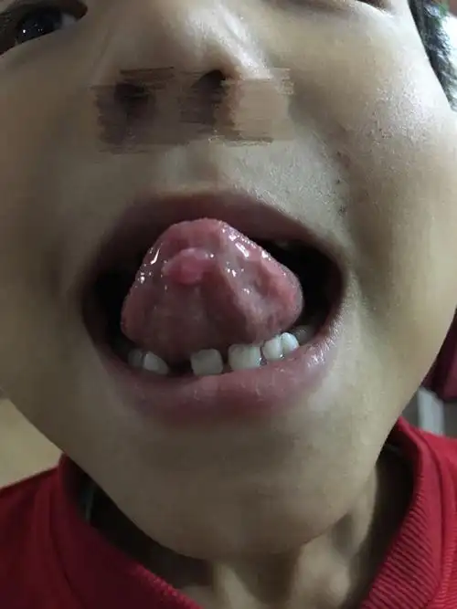 7岁孩子舌头下面长了一个豆粒大小的疙瘩,是什么原因导致的呢!