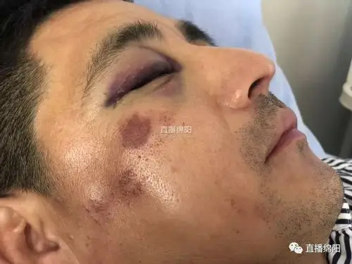 危险一吻绵阳一行人撞上广告牌颧骨骨折面临手术