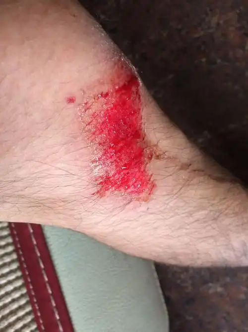 刚刚开车遇到狗在沙子刹车摔倒,现在膝盖旁边擦出血了,血好像油油的