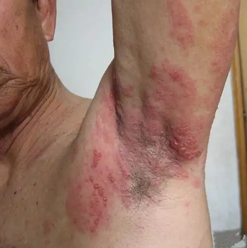 艾滋病初期腋下疱疹症状的图片