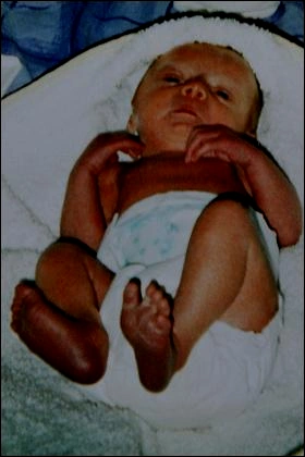 英国一名女孩在一岁时就被诊断患上早年衰老综合症(早衰症).