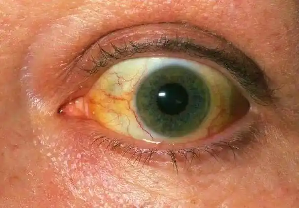 如果你有眼白发黄的现象请警惕