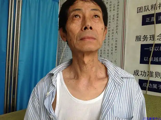 丝状疣的对比图片