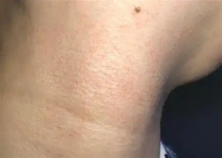 婴儿脸上热痱子的症状图片