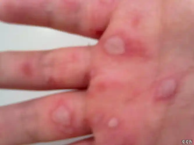 第一次见的双手掌水泡(有图)