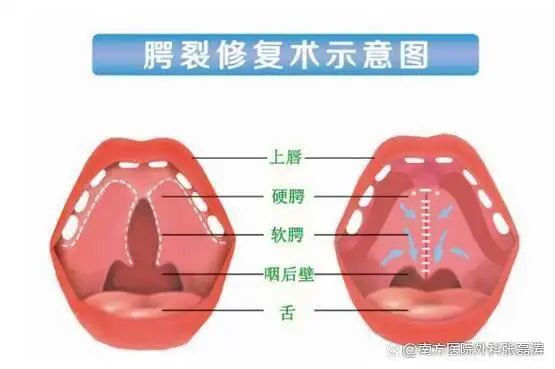 新生儿软腭裂能自愈吗?