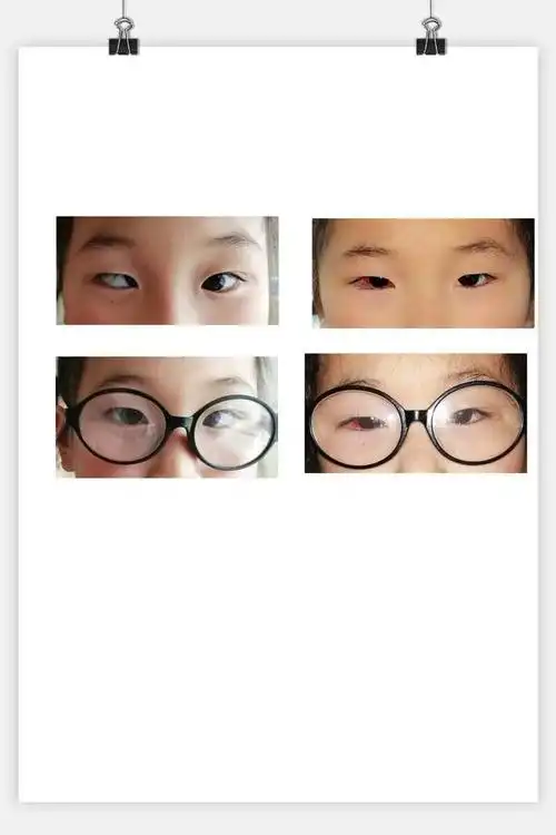 调节性内斜视 (原创)