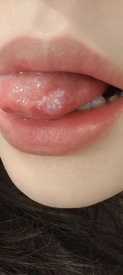 溃疡大家怎么治