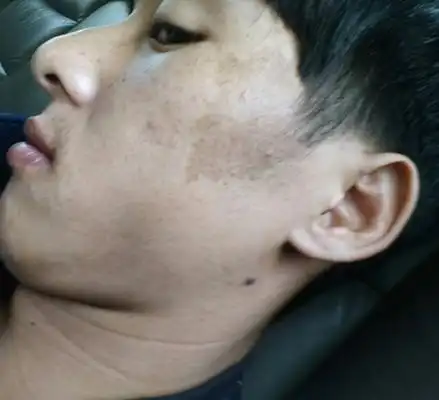 脸上黑斑 (26)_有来医生