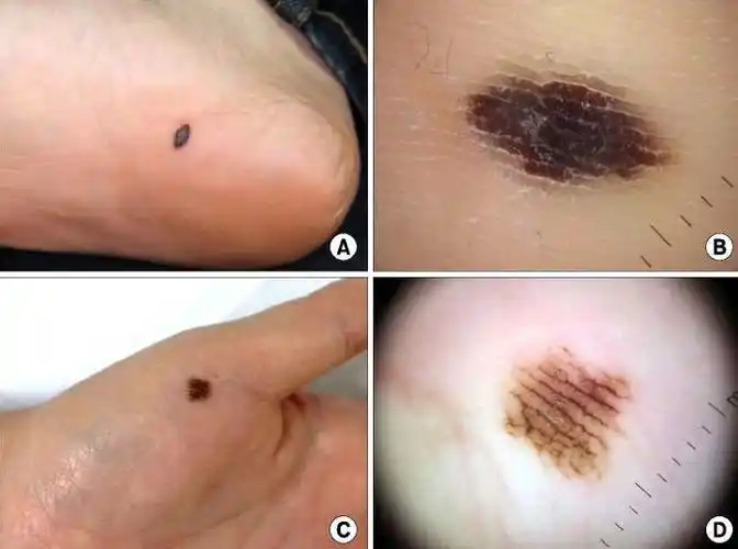 你身上的痣癌变可能有多大