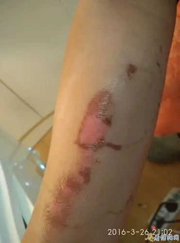 信阳金霞美容院操作失误致客户胳膊大面积烧伤理赔难