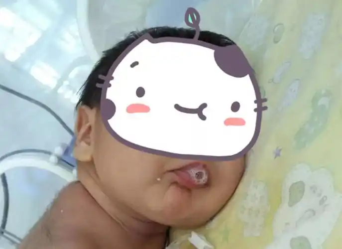 3.新生儿吐沫就是得了肺炎吗?