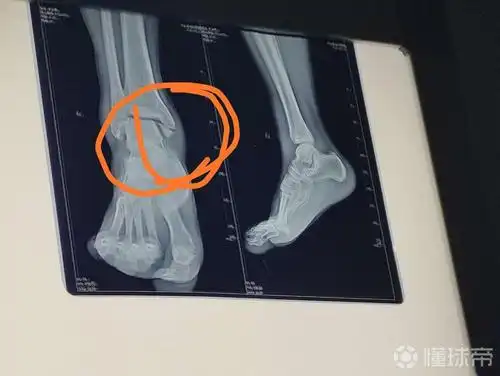 胫腓骨远端双侧骨折不知道多久能重回绿茵现在已