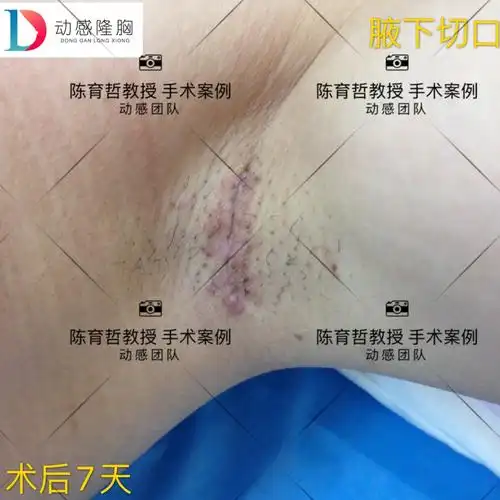 隆胸手术,腋窝疤痕能看到吗?