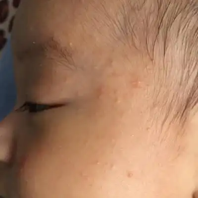 去医院大夫说是丘疹湿疹.孩子快三个月了,预防针还没扎呢.急急急