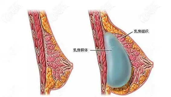 想要假体隆胸手感好,这些隆胸假体植入层次优缺点你一定要知道