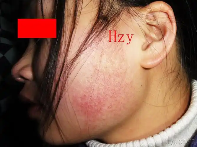 姑娘下颌角的皮损面颈部毛囊性红斑黑变病