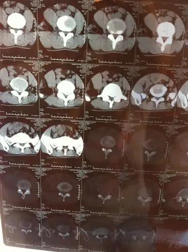 腰4/5椎间盘突出并椎管狭窄 腰5椎体上缘骨内软骨结构 严重吗?