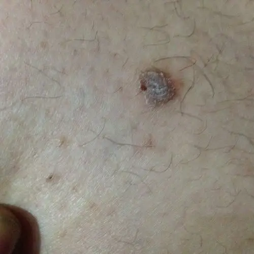 大腿外侧长了一个硬疙瘩很长时间了平时不疼不痒挠的厉害的