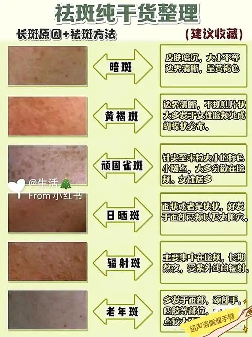 我们脸上的常见斑分为6种