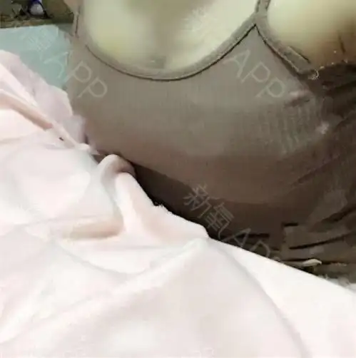 摸不出来假体,真实自然,和身材比例很和谐,吴院长做的胸型真的好漂亮!