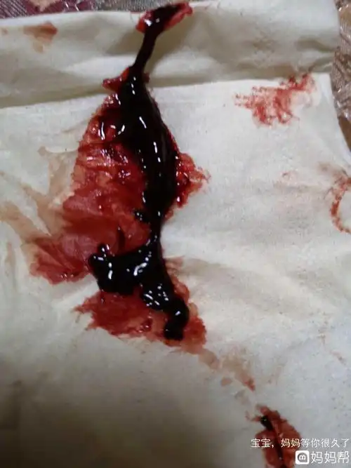 月经血块多是怎么回事|月经有血块是怎么回事?