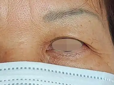 眼睑皮肤松弛症左眼上眼皮变薄下垂图