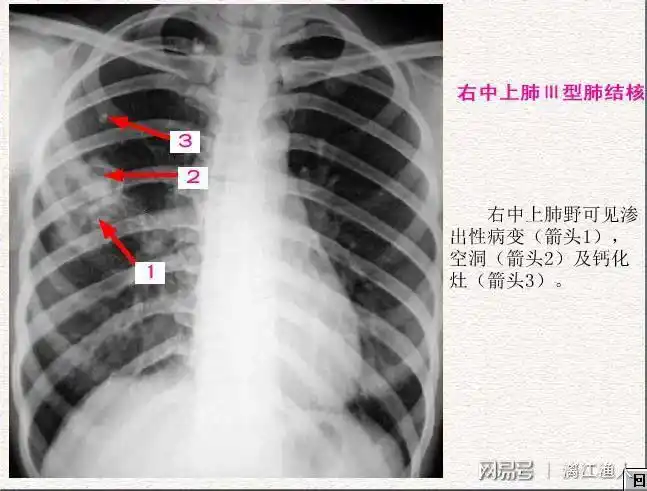 为什么没有肺炎心脏病去医院住院也要做胸片心电图