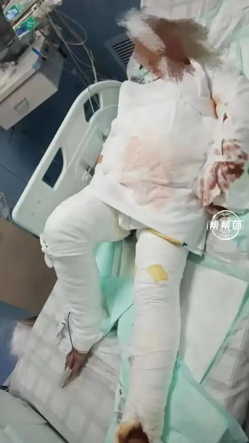全身包满纱布的父亲躺在icu里,用嘴型告诉女儿:先救妈妈!