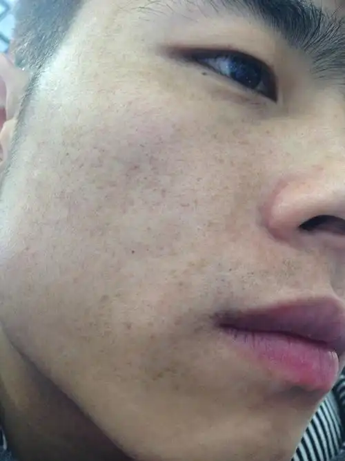 之前用过祛斑产品,一段时间后,留下了应该是黑色素的点状东西!有图!