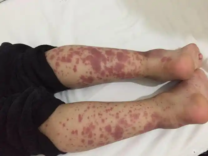 疑似过敏性紫癜 - 中医皮肤版 - 爱爱医医学论坛