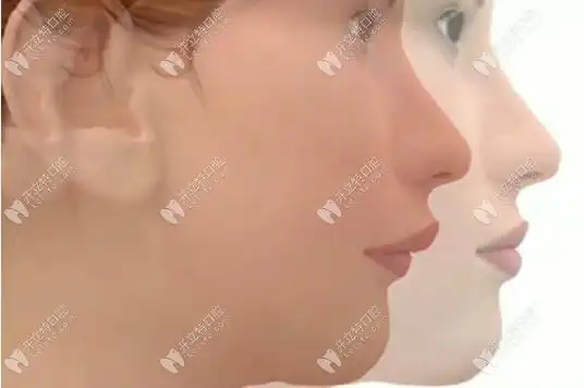 下巴后缩正颌手术前后对比图告诉你失败不可能的