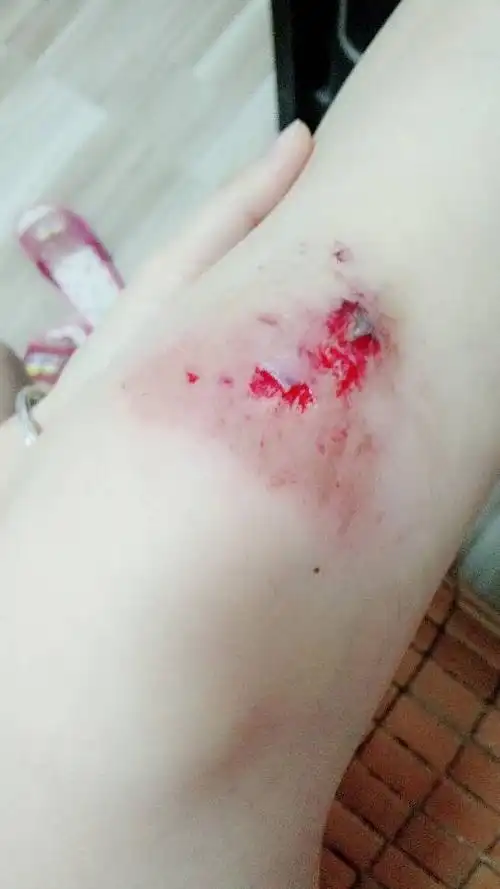 膝盖摔了两天不走路也有点疼