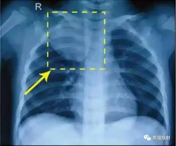 x线诊断要点丨气胸胸膜及胸壁病变