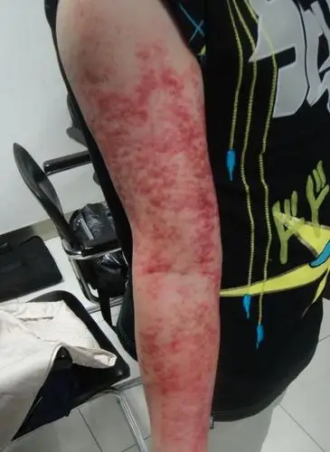 徐老师在给河北肃宁的学员刮胳膊河北肃宁的学员第二,脖子的刮痧演示