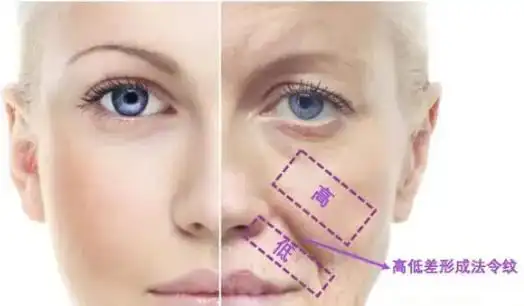 47岁了苹果肌下垂,法令纹重该怎么办?