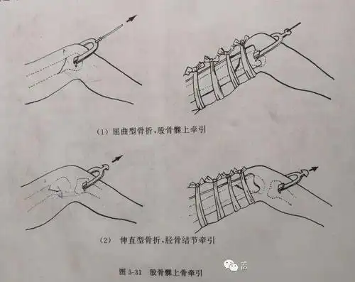 【武氏正骨】武氏正骨疗法治疗病例选登15_牵引