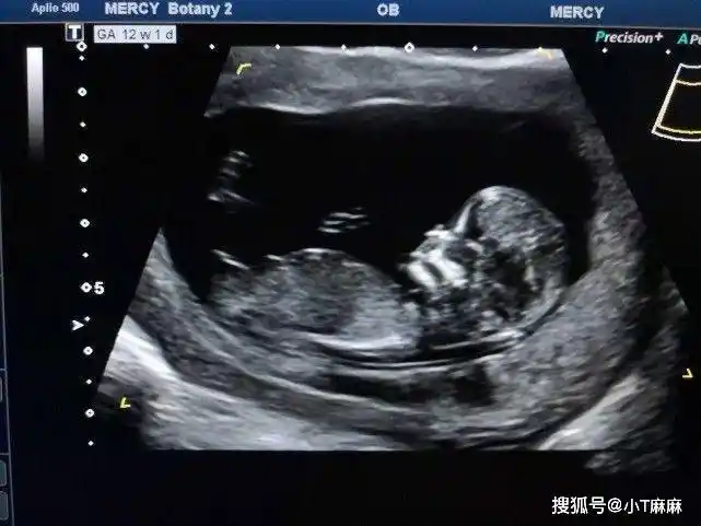 b超检测胎儿颈后透明层厚度nt检查 早期唐氏筛查填写表格,拿到母子