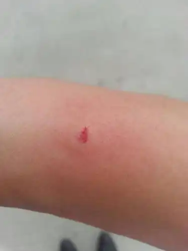 虱子长什么样放大图片虱子是怎么产生的