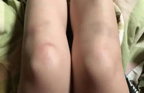 女生膝盖青了是什么梗