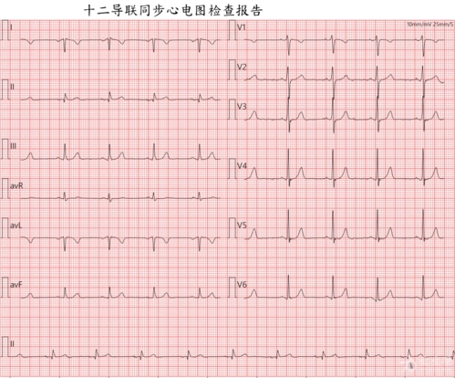 2.下面也是该患者的心电图,爱友们猜猜是怎样连接的?