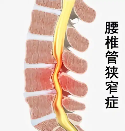 腰椎管狭窄症患者症状轻时常无明显不适.