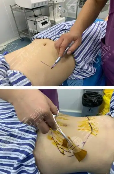 在线免费咨询价格)      手术结束以后,腹部有些许的疼痛感,但是这是