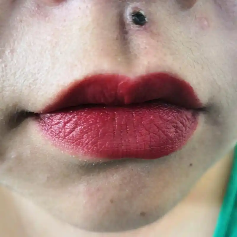 药水点痣 这个痣不记得什么时候长的了,越来越大,上面还开始长毛