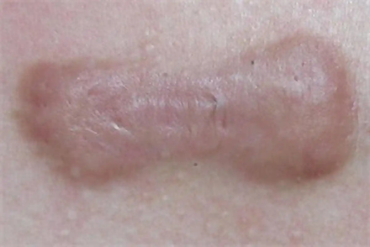 珠海皮肤医院# # 增生性瘢痕又称肥大性瘢痕,是皮肤或深部组织损苫蝌