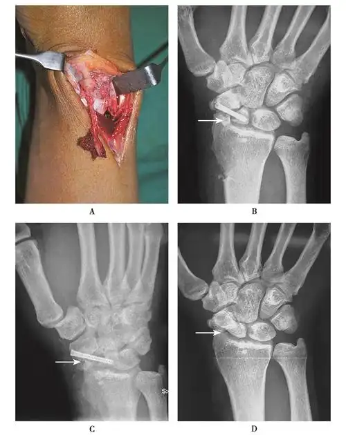 避免腕舟骨骨折并发症一定注意这几点
